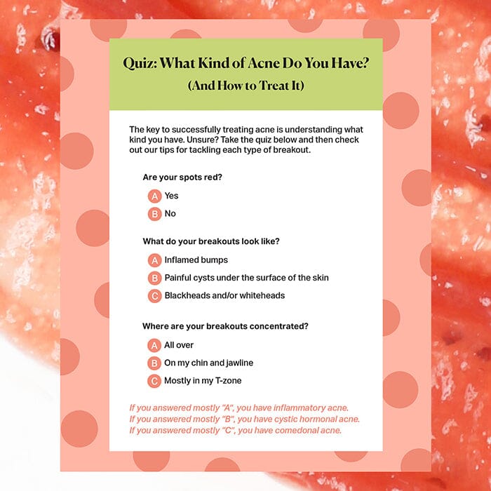 Cheat Sheet: Diagnosing and Treating Acne
