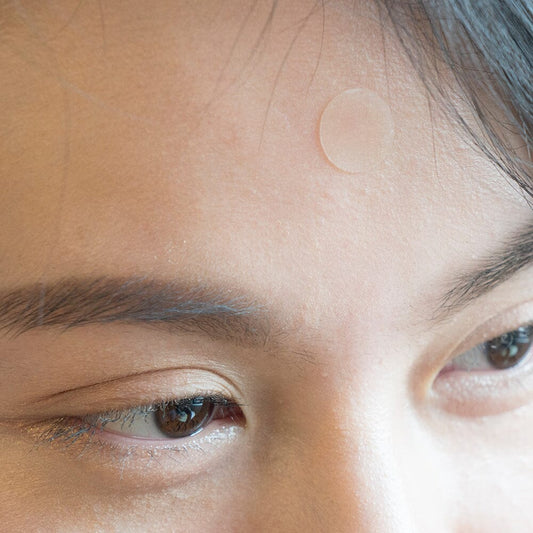 6 K-beauty Dupes for Popular Western Acne Spot Treatments