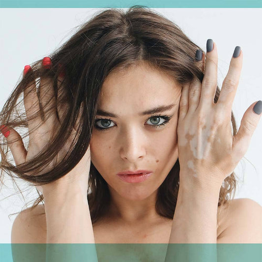 The Best Skin Care Tips for Vitiligo