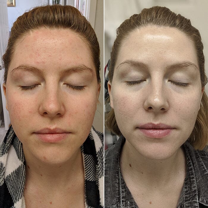 The Korean Skin Care Routine That Changed One Woman’s Sensitive, Acne-Prone Skin