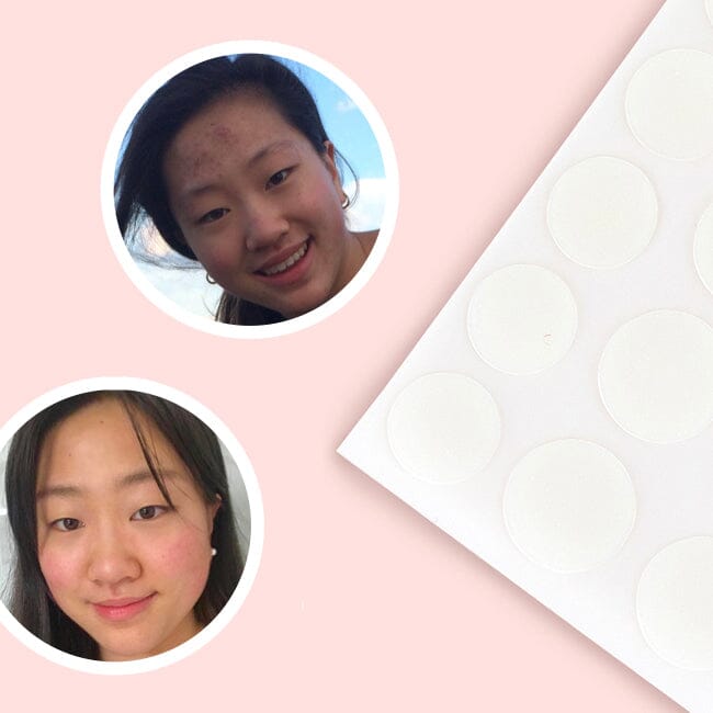 How This Skin Care-Obsessed Teen Cleared Her Acne on a Budget